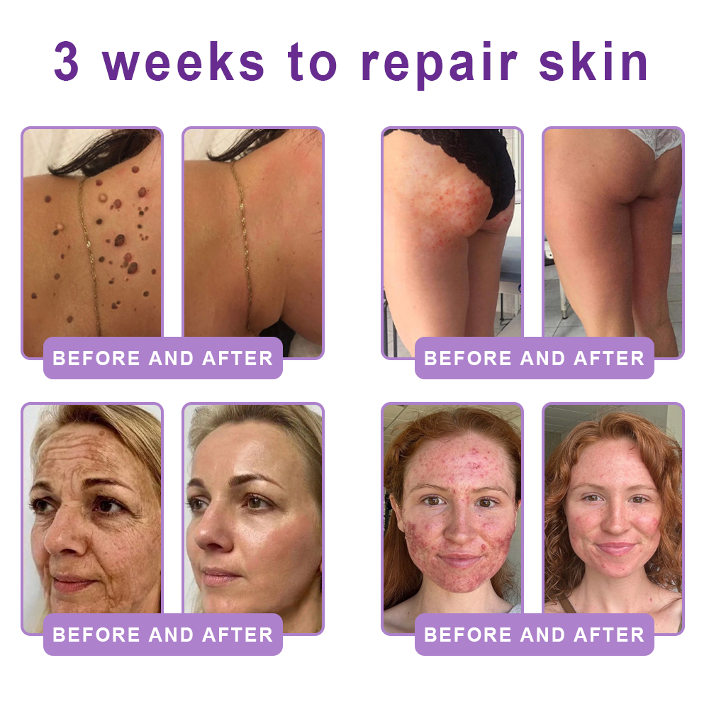 AU Australia Compliant : HISKIN® PDRN Multi-Peptide Massaging Body Roller Cream- Anti-aging, Hydrating, Skin Firming & Lifting, Skin Repair, Even Tone, Acne and Dark Spot Treatment, Wart and Mole Removal, and Psoriasis Relief.