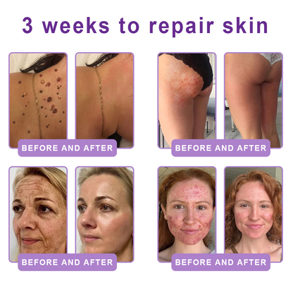 AU Australia Compliant : HISKIN® PDRN Multi-Peptide Massaging Body Roller Cream- Anti-aging, Hydrating, Skin Firming & Lifting, Skin Repair, Even Tone, Acne and Dark Spot Treatment, Wart and Mole Removal, and Psoriasis Relief.
