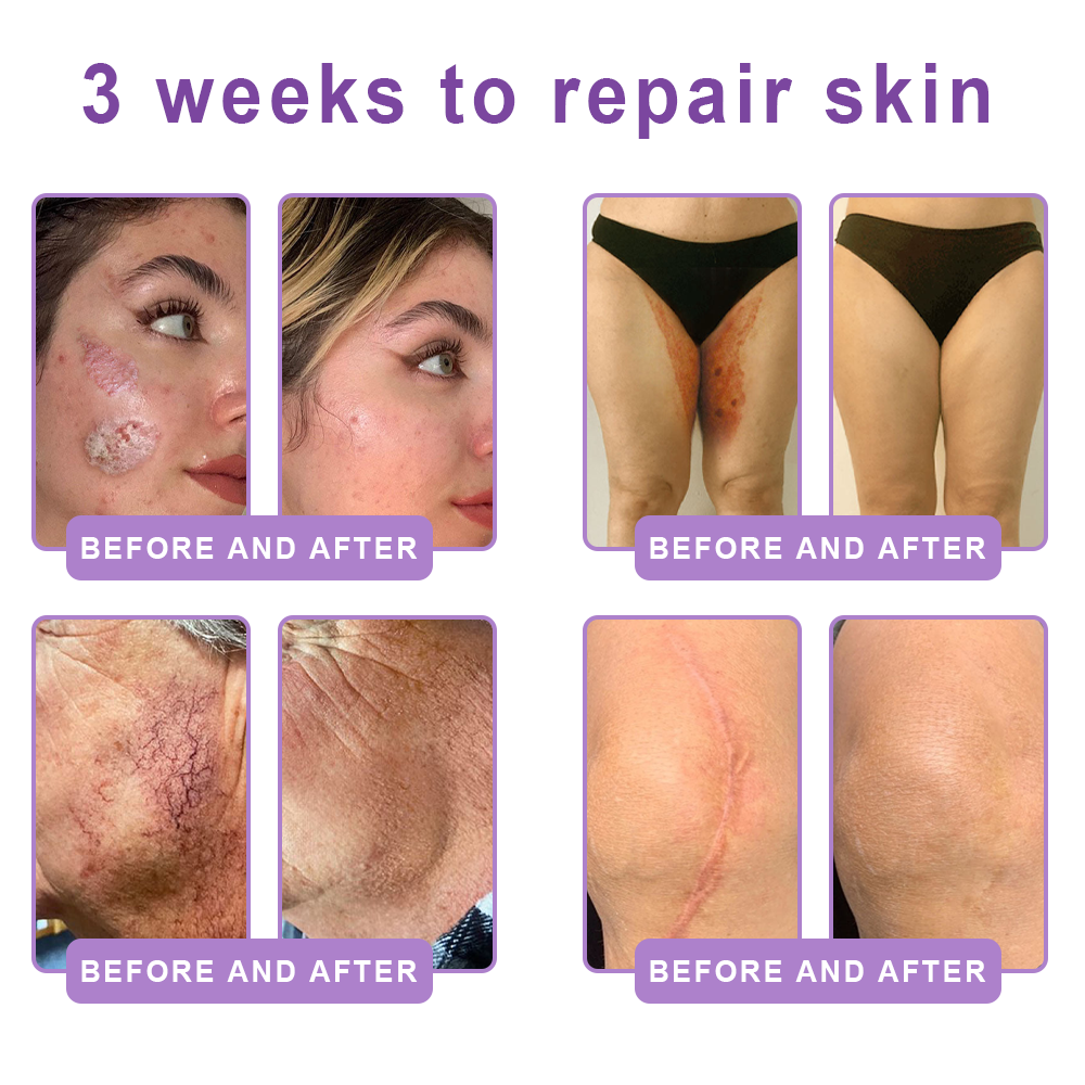 AU Australia Compliant : HISKIN® PDRN Multi-Peptide Massaging Body Roller Cream- Anti-aging, Hydrating, Skin Firming & Lifting, Skin Repair, Even Tone, Acne and Dark Spot Treatment, Wart and Mole Removal, and Psoriasis Relief.