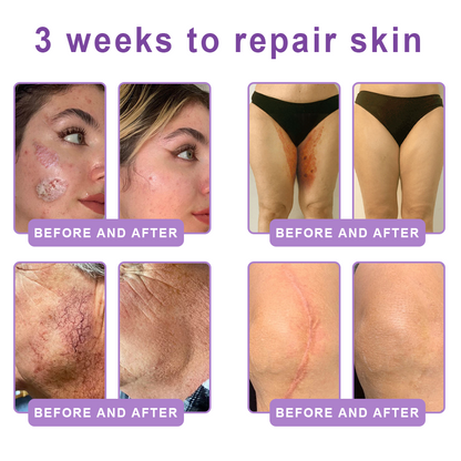 AU Australia Compliant : HISKIN® PDRN Multi-Peptide Massaging Body Roller Cream- Anti-aging, Hydrating, Skin Firming & Lifting, Skin Repair, Even Tone, Acne and Dark Spot Treatment, Wart and Mole Removal, and Psoriasis Relief.