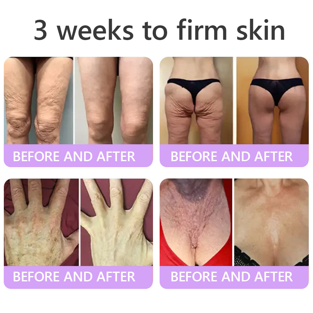 AU Australia Compliant : HISKIN® PDRN Multi-Peptide Massaging Body Roller Cream- Anti-aging, Hydrating, Skin Firming & Lifting, Skin Repair, Even Tone, Acne and Dark Spot Treatment, Wart and Mole Removal, and Psoriasis Relief.