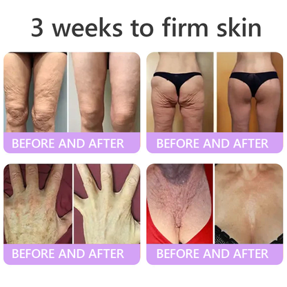 AU Australia Compliant : HISKIN® PDRN Multi-Peptide Massaging Body Roller Cream- Anti-aging, Hydrating, Skin Firming & Lifting, Skin Repair, Even Tone, Acne and Dark Spot Treatment, Wart and Mole Removal, and Psoriasis Relief.