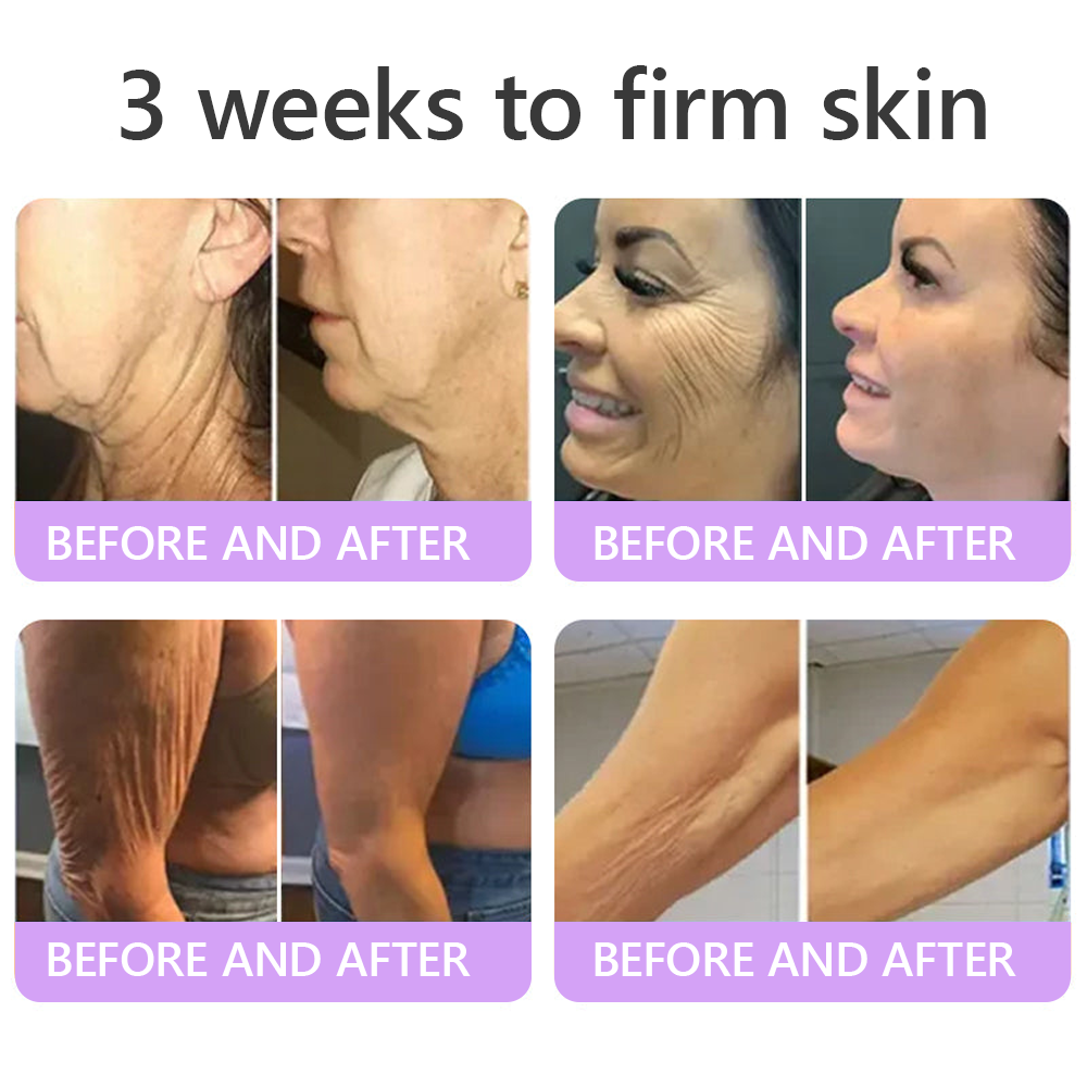 AU Australia Compliant : HISKIN® PDRN Multi-Peptide Massaging Body Roller Cream- Anti-aging, Hydrating, Skin Firming & Lifting, Skin Repair, Even Tone, Acne and Dark Spot Treatment, Wart and Mole Removal, and Psoriasis Relief.