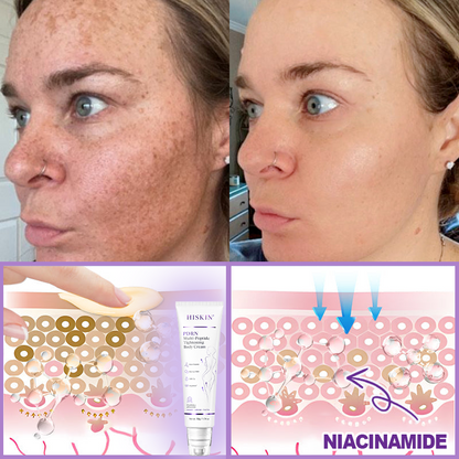 AU Australia Compliant : HISKIN® PDRN Multi-Peptide Massaging Body Roller Cream- Anti-aging, Hydrating, Skin Firming & Lifting, Skin Repair, Even Tone, Acne and Dark Spot Treatment, Wart and Mole Removal, and Psoriasis Relief.
