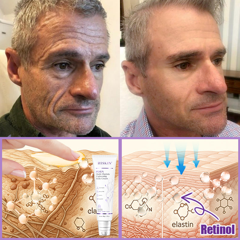 AU Australia Compliant : HISKIN® PDRN Multi-Peptide Massaging Body Roller Cream- Anti-aging, Hydrating, Skin Firming & Lifting, Skin Repair, Even Tone, Acne and Dark Spot Treatment, Wart and Mole Removal, and Psoriasis Relief.